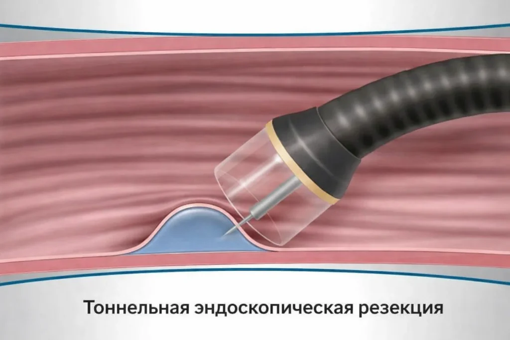 Тоннельная резекция: эндоскопическая операция изнутри, удалении опухолей Тоннельная резекция: эндоскопическая операция изнутри, удалении опухолей